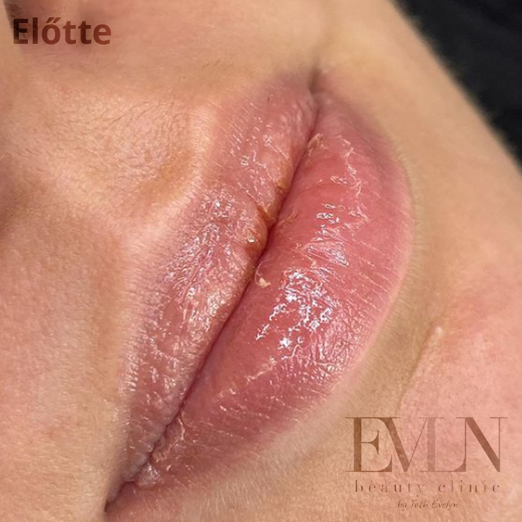 1elotte